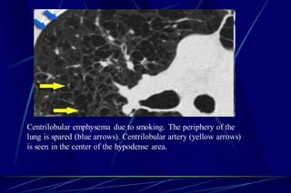 Centrilobular emphysema due to smoking. The periphery of the
lung is spared (blue arrows). Centrilobular artery (yellow arrows)
is seen in the center of the hypodense area.
 