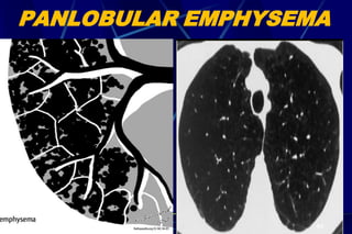 PANLOBULAR EMPHYSEMA
49
 