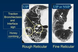 Rough Reticular Fine Reticular
Traction
Bronchiectasis
and
Interface
sign
Honey
combing
UIP UIP or NSIP
 