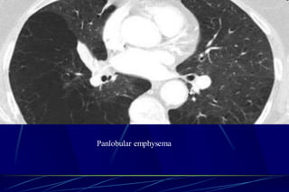 Panlobular emphysema
 