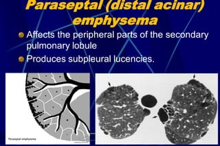 Paraseptal (distal acinar)
emphysema
Affects the peripheral parts of the secondary
pulmonary lobule
Produces subpleural lucencies.
51
 