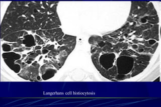Langerhans cell histiocytosis
 