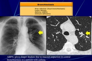 ABPA: glove-finger shadow due to mucoid impaction in central
bronchiectasis in a patient with asthma.
 