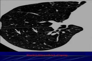 Bronchial dilation with lack of tapering .
 