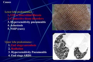 Causes
Lower lobe predominance :
1. UIP or interstitial fibrosis
2. Connective tissue disorders
3. Hypersensitivity pneumonitis
4.Asbestosis
5. NSIP (rare)
Upper lobe predominance :
1. End stage sarcodosis
2. Radiation
3. Hypersensitivity Pneumonitis
4. End stageARDS
64
 