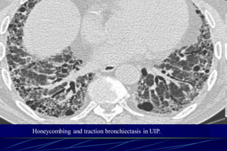 Honeycombing and traction bronchiectasis in UIP.
 
