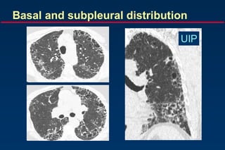 Basal and subpleural distribution
UIP
 
