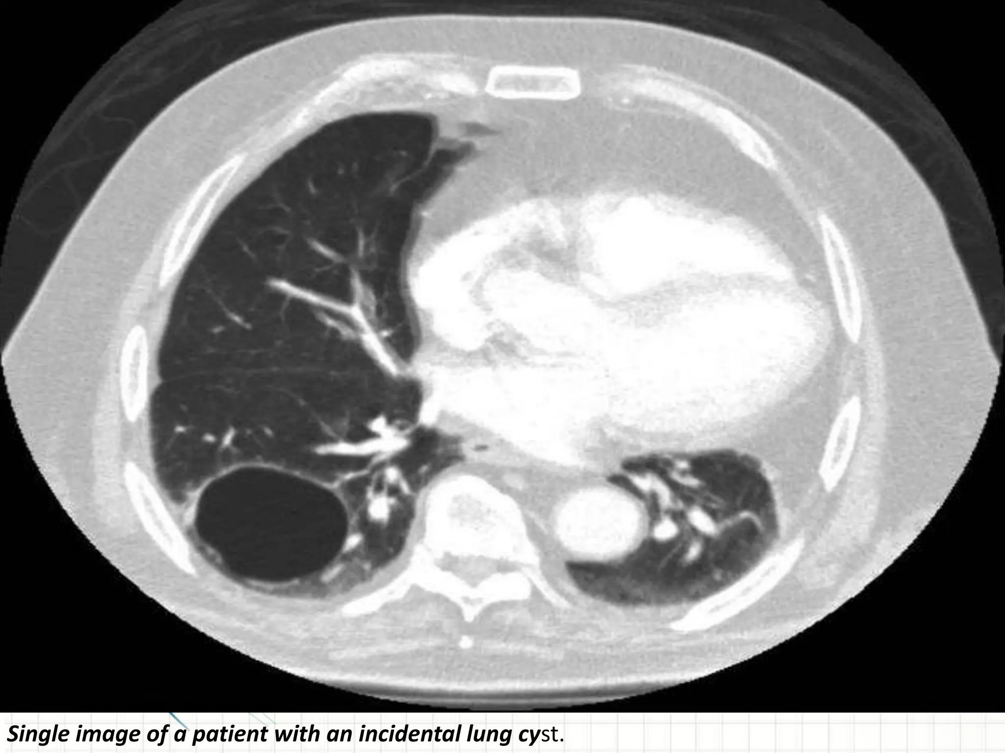 Single image of a patient with an incidental lung cyst.
 