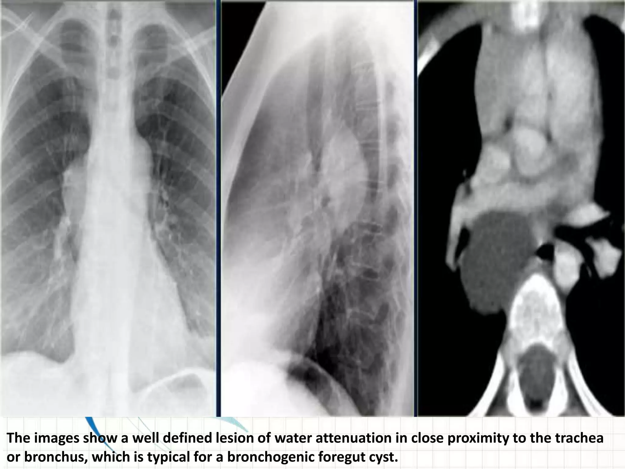 The images show a well defined lesion of water attenuation in close proximity to the trachea
or bronchus, which is typical for a bronchogenic foregut cyst.
 