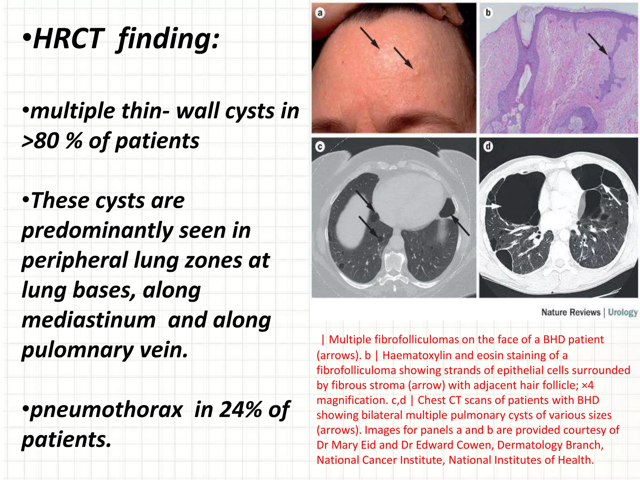 | Multiple fibrofolliculomas on the face of a BHD patient
(arrows). b | Haematoxylin and eosin staining of a
fibrofolliculoma showing strands of epithelial cells surrounded
by fibrous stroma (arrow) with adjacent hair follicle; ×4
magnification. c,d | Chest CT scans of patients with BHD
showing bilateral multiple pulmonary cysts of various sizes
(arrows). Images for panels a and b are provided courtesy of
Dr Mary Eid and Dr Edward Cowen, Dermatology Branch,
National Cancer Institute, National Institutes of Health.
•HRCT finding:
•multiple thin- wall cysts in
>80 % of patients
•These cysts are
predominantly seen in
peripheral lung zones at
lung bases, along
mediastinum and along
pulomnary vein.
•pneumothorax in 24% of
patients.
 