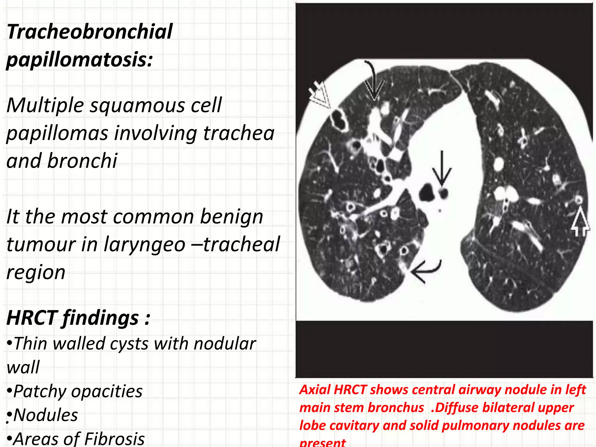 .
Axial HRCT shows central airway nodule in left
main stem bronchus .Diffuse bilateral upper
lobe cavitary and solid pulmonary nodules are
Tracheobronchial
papillomatosis:
Multiple squamous cell
papillomas involving trachea
and bronchi
It the most common benign
tumour in laryngeo –tracheal
region
HRCT findings :
•Thin walled cysts with nodular
wall
•Patchy opacities
•Nodules
•Areas of Fibrosis
 