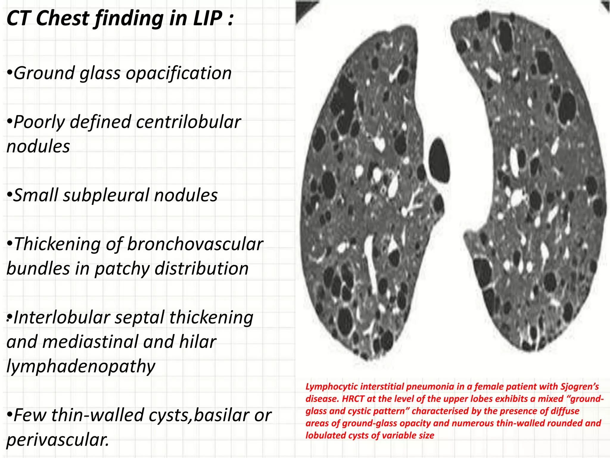 Lymphocytic interstitial pneumonia in a female patient with Sjogren’s
disease. HRCT at the level of the upper lobes exhibits a mixed “ground-
glass and cystic pattern” characterised by the presence of diffuse
areas of ground-glass opacity and numerous thin-walled rounded and
lobulated cysts of variable size
.
CT Chest finding in LIP :
•Ground glass opacification
•Poorly defined centrilobular
nodules
•Small subpleural nodules
•Thickening of bronchovascular
bundles in patchy distribution
•Interlobular septal thickening
and mediastinal and hilar
lymphadenopathy
•Few thin-walled cysts,basilar or
perivascular.
 
