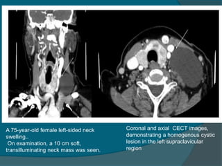 cystic neck lesions congenital and acquired | PPTX