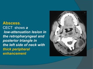 cystic neck lesions congenital and acquired | PPTX