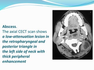 Cystic masses of neck | PPTX