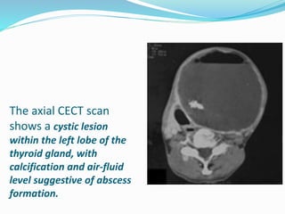 Cystic masses of neck | PPTX