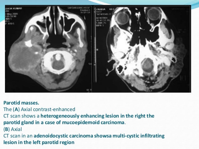 Cystic masses of neck