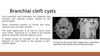 Branchial cleft cysts
First branchial cleft anomalies are relatively less
common and typically closely related to the
parotid gland.
These commonly present as fistula and sinus,
whereas cysts are least common.
The usual appearance is an oval or round cystic
mass within, superficial to, or deep to the parotid
gland or along the external auditory canal.
It should always be included in the differential
diagnosis of cystic lesion in the parotid or peri-
parotid region.
(A) Axial and (B) coronal CECT images show a well defined
hypodense mass (arrows) within the right parotid gland
 