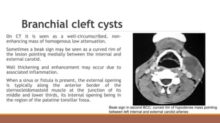 Branchial cleft cysts
On CT it is seen as a well-circumscribed, non-
enhancing mass of homogenous low attenuation.
Sometimes a beak sign may be seen as a curved rim of
the lesion pointing medially between the internal and
external carotid.
Wall thickening and enhancement may occur due to
associated inflammation.
When a sinus or fistula is present, the external opening
is typically along the anterior border of the
sternocleidomastoid muscle at the junction of its
middle and lower thirds, its internal opening being in
the region of the palatine tonsillar fossa.
Beak sign in second BCC: curved rim of hypodense mass pointing
between left internal and external carotid arteries
 