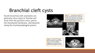 Branchial cleft cysts
Fourth branchial cleft anomalies are
generally sinus tracts or fistulae and
arise from the pyriform sinus, pierce
the thyrohyoid membrane, and descend
along the tracheoesophageal groove.
 
