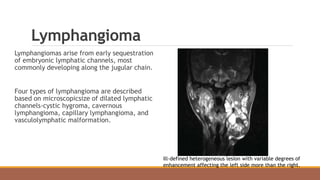 Lymphangioma
Lymphangiomas arise from early sequestration
of embryonic lymphatic channels, most
commonly developing along the jugular chain.
Four types of lymphangioma are described
based on microscopicsize of dilated lymphatic
channels-cystic hygroma, cavernous
lymphangioma, capillary lymphangioma, and
vasculolymphatic malformation.
Ill-defined heterogeneous lesion with variable degrees of
enhancement affecting the left side more than the right.
 