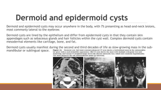 Dermoid and epidermoid cysts
Dermoid and epidermoid cysts may occur anywhere in the body, with 7% presenting as head-and-neck lesions,
most commonly lateral to the eyebrow.
Dermoid cysts are lined by the epithelium and differ from epidermoid cysts in that they contain skin
appendages such as sebaceous glands and hair follicles within the cyst wall. Complex dermoid cysts contain
mesodermal elements like cartilage, bone, and fat.
Dermoid cysts usually manifest during the second and third decades of life as slow-growing mass in the sub-
mandibular or sublingual space.
 