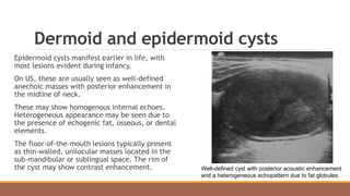 Dermoid and epidermoid cysts
Epidermoid cysts manifest earlier in life, with
most lesions evident during infancy.
On US, these are usually seen as well-defined
anechoic masses with posterior enhancement in
the midline of neck.
These may show homogenous internal echoes.
Heterogeneous appearance may be seen due to
the presence of echogenic fat, osseous, or dental
elements.
The floor-of-the-mouth lesions typically present
as thin-walled, unilocular masses located in the
sub-mandibular or sublingual space. The rim of
the cyst may show contrast enhancement. Well-defined cyst with posterior acoustic enhancement
and a heterogeneous echopattern due to fat globules
 