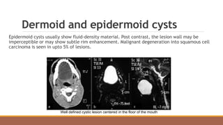 Dermoid and epidermoid cysts
Epidermoid cysts usually show fluid-density material. Post contrast, the lesion wall may be
imperceptible or may show subtle rim enhancement. Malignant degeneration into squamous cell
carcinoma is seen in upto 5% of lesions.
Well defined cystic lesion centered in the floor of the mouth
 