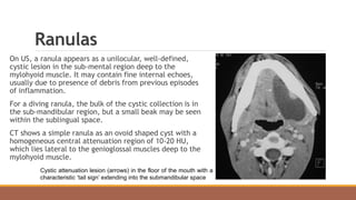 Ranulas
On US, a ranula appears as a unilocular, well-defined,
cystic lesion in the sub-mental region deep to the
mylohyoid muscle. It may contain fine internal echoes,
usually due to presence of debris from previous episodes
of inflammation.
For a diving ranula, the bulk of the cystic collection is in
the sub-mandibular region, but a small beak may be seen
within the sublingual space.
CT shows a simple ranula as an ovoid shaped cyst with a
homogeneous central attenuation region of 10-20 HU,
which lies lateral to the genioglossal muscles deep to the
mylohyoid muscle.
Cystic attenuation lesion (arrows) in the floor of the mouth with a
characteristic ‘tail sign’ extending into the submandibular space
 