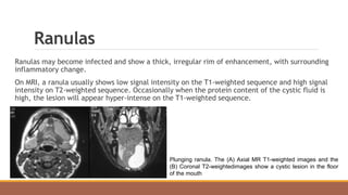 Ranulas
Ranulas may become infected and show a thick, irregular rim of enhancement, with surrounding
inflammatory change.
On MRI, a ranula usually shows low signal intensity on the T1-weighted sequence and high signal
intensity on T2-weighted sequence. Occasionally when the protein content of the cystic fluid is
high, the lesion will appear hyper-intense on the T1-weighted sequence.
Plunging ranula. The (A) Axial MR T1-weighted images and the
(B) Coronal T2-weightedimages show a cystic lesion in the floor
of the mouth
 