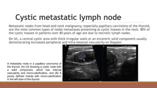 Cystic metastatic lymph node
Metastatic nodes from head-and-neck malignancy, especially papillary carcinoma of the thyroid,
are the most common types of nodal metastases presenting as cystic masses in the neck. 80% of
the cystic masses in patients over 40 years of age are due to necrotic lymph nodes.
On US, a central cystic area with thick irregular walls or an eccentric solid component usually
demonstrating increased peripheral and intra-lesional vascularity on Doppler.
A metastatic node in a papillary carcinoma of
the thyroid. (A) US showing a cystic node with
a solid component, which has internal
vascularity and micro-calcification, and (B) A
poorly defined nodule with micro-calcification
in the left lobe of the thyroid
 