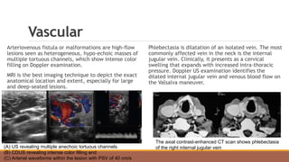 Vascular
Arteriovenous fistula or malformations are high-flow
lesions seen as heterogeneous, hypo-echoic masses of
multiple tortuous channels, which show intense color
filling on Doppler examination.
MRI is the best imaging technique to depict the exact
anatomical location and extent, especially for large
and deep-seated lesions.
Phlebectasia is dilatation of an isolated vein. The most
commonly affected vein in the neck is the internal
jugular vein. Clinically, it presents as a cervical
swelling that expands with increased intra-thoracic
pressure. Doppler US examination identifies the
dilated internal jugular vein and venous blood flow on
the Valsalva maneuver.
(A) US revealing multiple anechoic tortuous channels.
(B) CDUS revealing intense color filling and
(C) Arterial waveforms within the lesion with PSV of 40 cm/s
The axial contrast-enhanced CT scan shows phlebectasia
of the right internal jugular vein
 