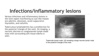 Infections/inflammatory lesions
Various infections and inflammatory lesions in
the neck region manifesting as cyst-like masses
are adenitis, abscesses, acute suppurative
thyroiditis, and cellulitis.
Tuberculous lymphadenitis has a predilection for
the posterior triangle of the neck. On imaging, a
necrotic discrete or conglomerate lymph nodal
mass with surrounding soft-tissue edema is
seen.
Tubercular lymph node. US revealing a large necrotic lymph node
in the posterior triangle of the neck
 