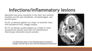 Infections/inflammatory lesions
Abscesses may occur anywhere in the neck, but common
locations are the sub-mandibular, retropharyngeal, and
parotid space.
On US, an abscess appears as a hypo- to anechoic mass,
with peripheral thick, shaggy margins.
On CT, an abscess usually appears as a single or multi-
loculated low-density area with rim enhancement.
Internal gas collections may be present.
Low-attenuation lesion in the retropharyngeal and posterior
triangle in the left side of neck with thick peripheral enhancement
 