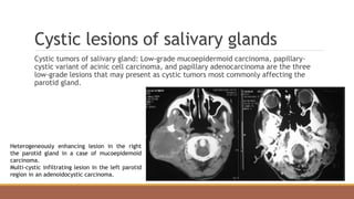 Cystic lesions of salivary glands
Cystic tumors of salivary gland: Low-grade mucoepidermoid carcinoma, papillary-
cystic variant of acinic cell carcinoma, and papillary adenocarcinoma are the three
low-grade lesions that may present as cystic tumors most commonly affecting the
parotid gland.
Heterogeneously enhancing lesion in the right
the parotid gland in a case of mucoepidemoid
carcinoma.
Multi-cystic infiltrating lesion in the left parotid
region in an adenoidocystic carcinoma.
 