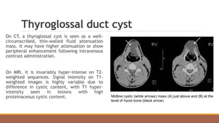 Thyroglossal duct cyst
On CT, a thyroglossal cyst is seen as a well-
circumscribed, thin-walled fluid attenuation
mass. It may have higher attenuation or show
peripheral enhancement following intravenous
contrast administration.
On MRI, it is invariably hyper-intense on T2-
weighted sequences. Signal intensity on T1-
weighted images is highly variable due to
difference in cystic content, with T1 hyper-
intensity seen in lesions with high
proteinaceous cystic content. Midline cystic (white arrows) mass (A) just above and (B) at the
level of hyoid bone (black arrow)
 