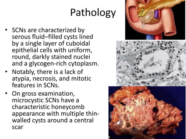 Cystic neoplasm of pancreas | PPTX | Brain and Nervous System Disorders ...