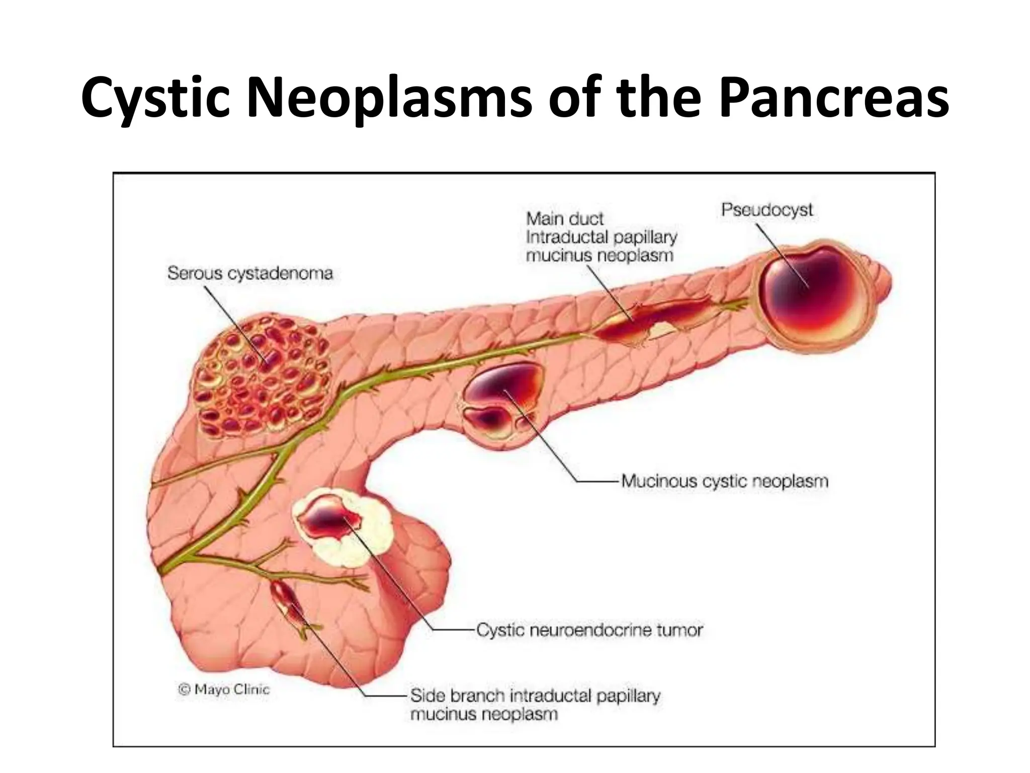 basics on Cystic neoplasms of the pancreas.pptx