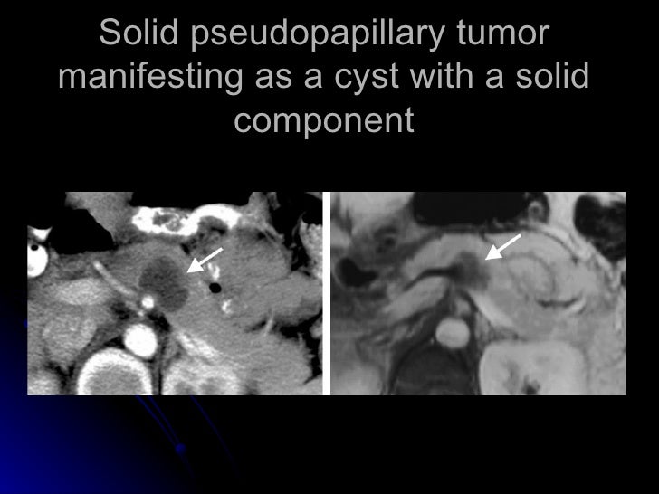 Cystic pancreatic lesions