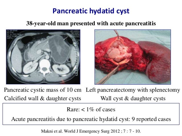 Pancreatic Hydatid Cyst Pancreatic Hydatid Cyst