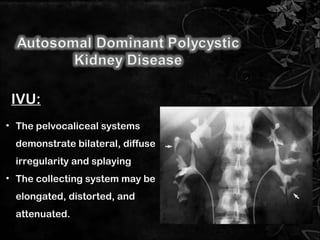 • The pelvocaliceal systems
demonstrate bilateral, diffuse
irregularity and splaying
• The collecting system may be
elongated, distorted, and
attenuated.
IVU:
10
 