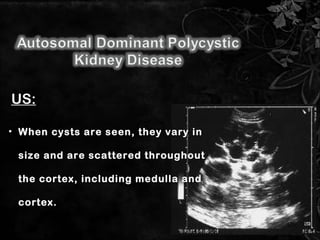 • When cysts are seen, they vary inWhen cysts are seen, they vary in
size and are scattered throughoutsize and are scattered throughout
the cortex, including medulla andthe cortex, including medulla and
cortex.cortex.
US:
12
 