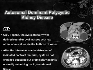 • On CT scans, the cysts are fairly well-
defined round or oval masses with low
attenuation values similar to those of water.
• After the intravenous administration of
iodinated contrast material, cysts do not
enhance but stand out prominently against
normally enhancing background renal
tissue.
CT:
13
 