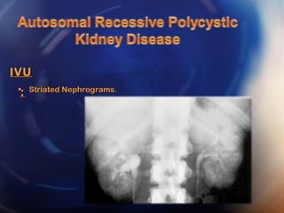 • Striated Nephrograms.Striated Nephrograms.
IVUIVU
::
 