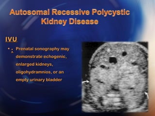 • Prenatal sonography mayPrenatal sonography may
demonstrate echogenic,demonstrate echogenic,
enlarged kidneys,enlarged kidneys,
oligohydramnios, or anoligohydramnios, or an
empty urinary bladderempty urinary bladder
IVUIVU
::
 
