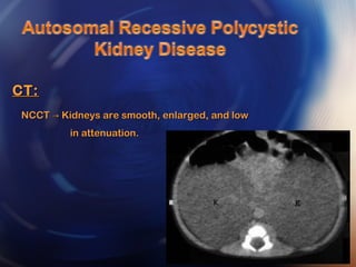 CT:CT:
NCCT Kidneys are smooth, enlarged, and low→NCCT Kidneys are smooth, enlarged, and low→
in attenuation.in attenuation.
 