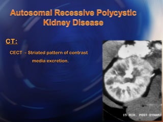 CT:CT:
CECT Striated pattern of contrast→CECT Striated pattern of contrast→
media excretion.media excretion.
 