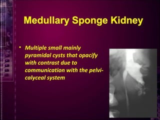 33
• Multiple small mainly
pyramidal cysts that opacify
with contrast due to
communication with the pelvi-
calyceal system
 