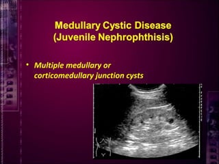 • Multiple medullary or
corticomedullary junction cysts
 