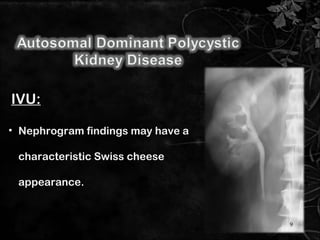 • Nephrogram findings may have a
characteristic Swiss cheese
appearance.
IVU:
9
 